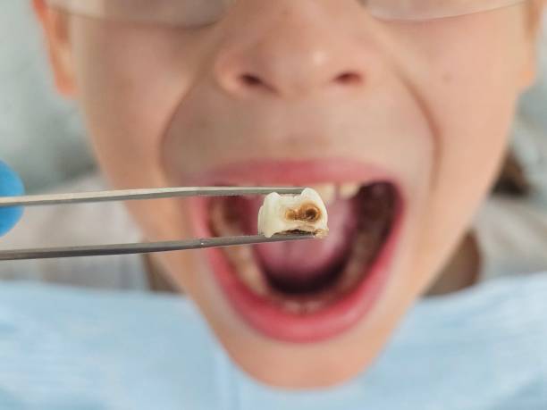 Best Emergency Tooth Extraction in Woodville, CA